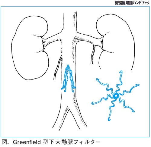 図.Greenfield型下大静脈フィルター