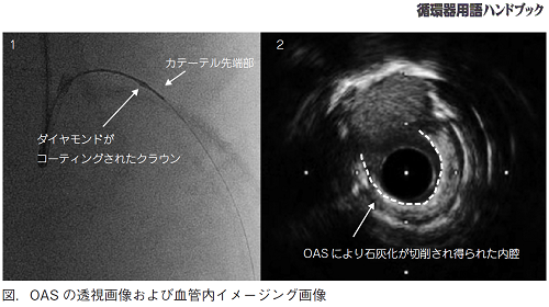 OASの透視画像および血管内イメージング画像