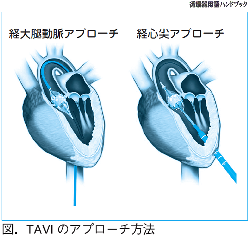 図.TAVIのアプローチ方法