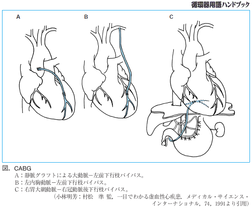 図.CABG