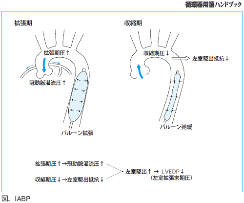 図.IABP