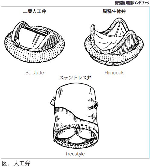 図.人工弁