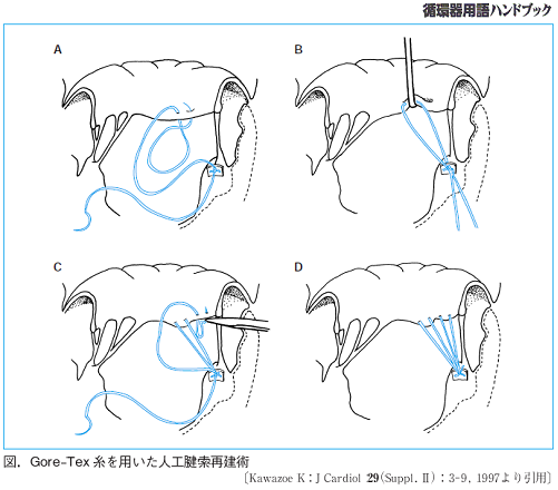 図.Gore-Tex糸を用いた人工腱索再建術