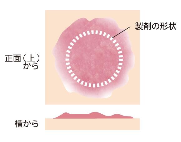 アレルギー性接触皮膚炎