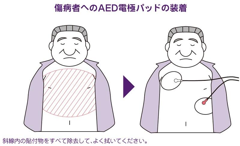 病傷者へのAED電極パッドの装着